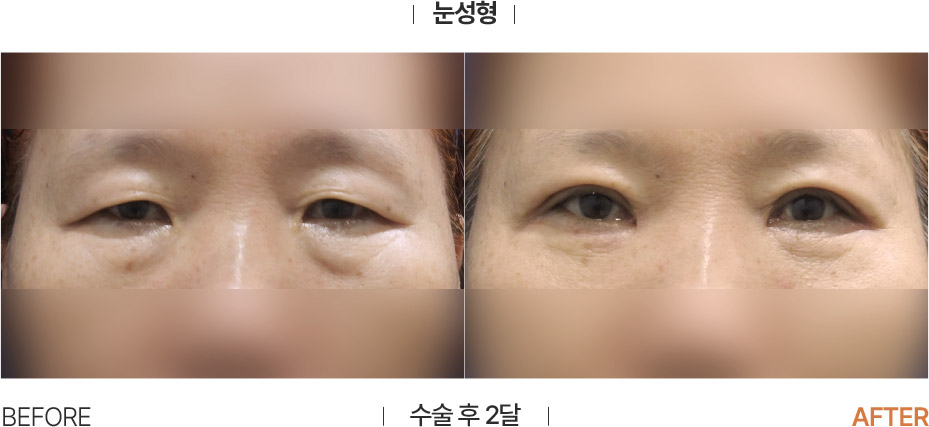 Eye surgery before and after