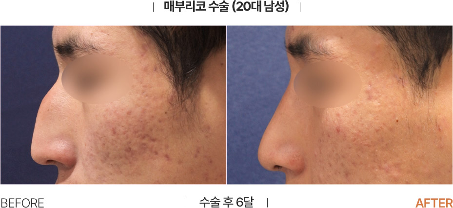 Rhinoplasty before and after