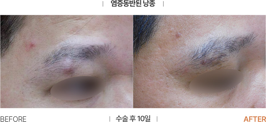 Scar treatment before and after